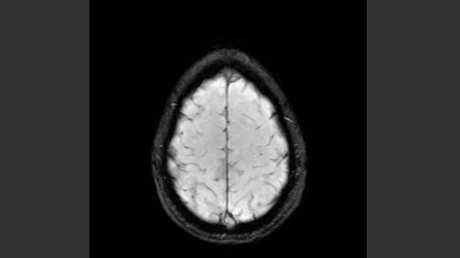Little hits in sports may be just as dangerous as concussions – and can lead to brain damage
