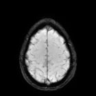 Little hits in sports may be just as dangerous as concussions – and can lead to brain damage