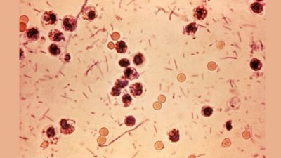 Kerala reports eight more Shigella cases as June tally rises to 180